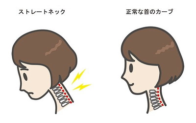 ストレートネック