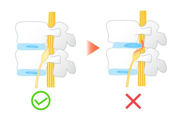 椎間板ヘルニアについて