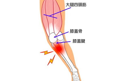 オスグッド・シュラッター病
