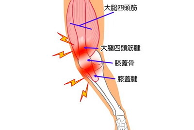 大腿四頭筋腱炎（ジャンパー膝）
