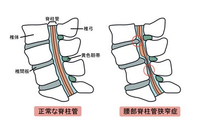 腰部脊柱管狭窄症
