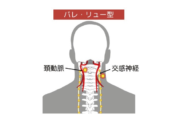 バレ・リュー型