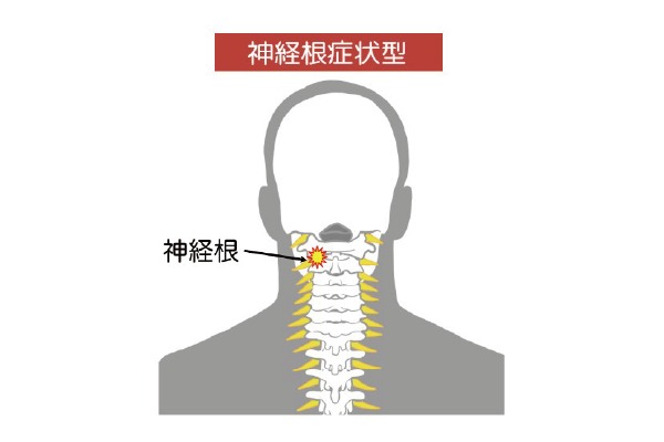 神経根症状型